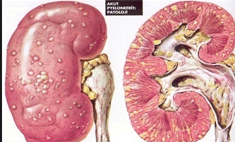 Nefritli bir böbreğin içten ve dıştan görünüşü