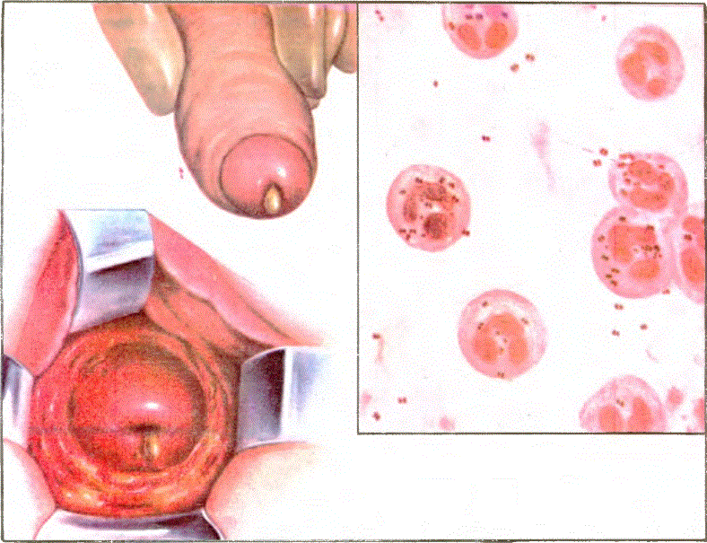 Üst: Erkekte gonoreye bağlı olarak penisten gelen akıntı (söğ üst). Kadının rahim boynu ve vaginasında akıntı (alt). Nokta biçiminde çift çift duran gonore mikropları ve akyuvarlar (sol). Sol: Gonoreye bağlı olarak kadının üretra kanalının yakınında apse gelişmesi ve bunun yol açtığı şişliğin vaginadan görünümü. Alt: Gonore mikrobu.
