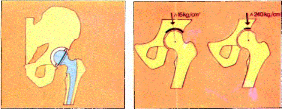Uyluk kemiğinin başı kötü bir biçimde kırıldığında, kırılan bölümün yerine yapay olanı takılabilir (sol). Uyluk kemiği başıyla, peJvis arasındaki kalça ekleminin temas yüzeyi geniş olduğunda, vücudun yükü uygun bir biçimde eklem yüzeyine biner (sağ).
