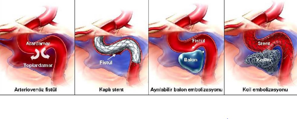 arteriovenoz-fistuller
