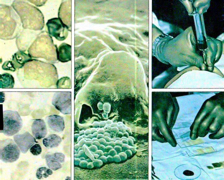 Akut lösemiler. Lösemi hastasının kemik iliği (sol üst) ve kan hücreleri (alt). Lösemili hücrelerin enjektöre alınması (sağ üst) ve virüs sayımı (alt).