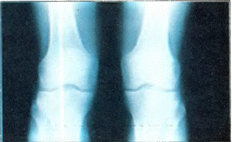 Diz eklemini oluşturan kemiklerin röntgeni