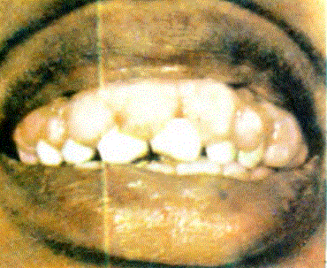 Dişeti büyümeleri. Gingiva hiperplazileri adını da alır. Aşırı büyümeler dişler arasındaki aralığı arttırır, diş sürmelerini engelleyebilir
