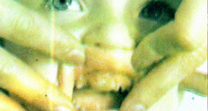 Epulis. Dev hücreli reparatif granulom bir epulis türüdür. Küçük çocuğun üstçenesinde ve dişlerin üzerini örtecek biçimde gelişmiştir. Selim bir oluşumdur