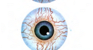 Glokomlu gözler (üst) ve konyanktritli gözler