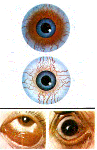 Glokomlu gözler (üst) ve konyanktritli gözler 