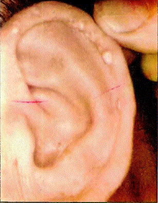 Kulak sayvanındaki gut tofvs