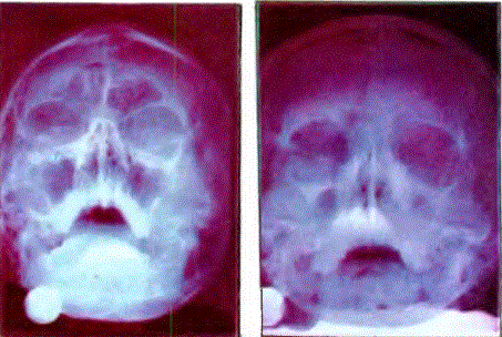 Normal sinusların (sol) ve iltihapla ımış sinuslarm (sağ) röntgeni.