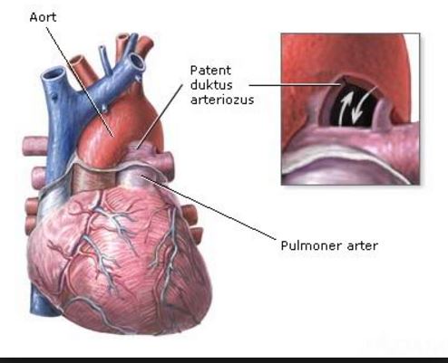 patent-duktus-arteriozus