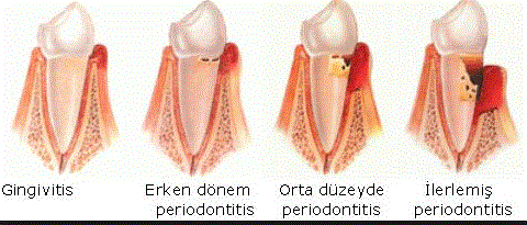 periodontal-hastaliklar