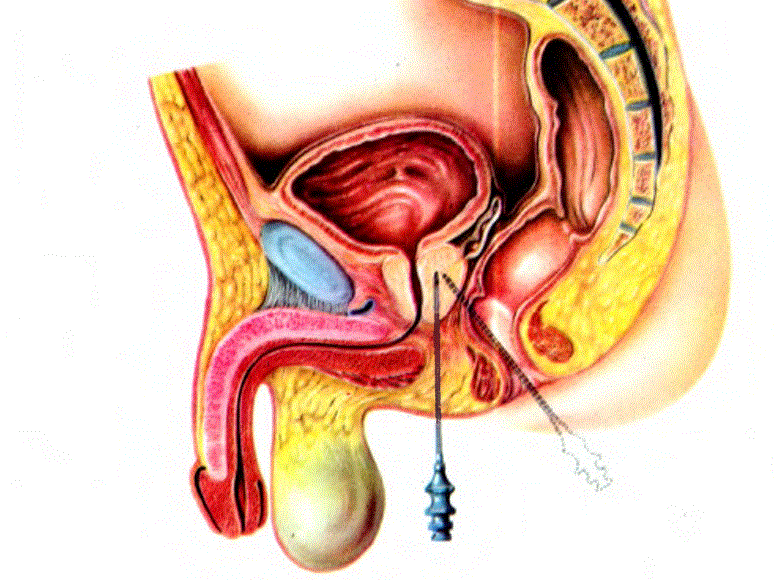Prostat bezinin yeri iğne ile gösterilmiştir.