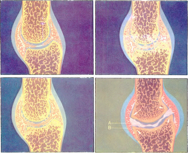 Romatoid artritte eklemdeki iltihap oJayınm gelişimini gösteren çizimler. A- Kısmen haaplanmış eklem kıkırdağı. B- Osteofit.