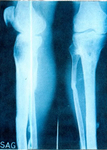 Sağ bacağın fibulö kemiğindeki kırığı önden ve yandan gösteren röntgen filmi
