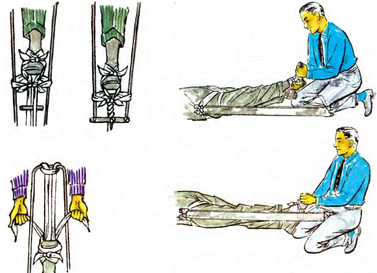 Tek bacağın taşıma tahtasında sabitleştirilmesi Sabit çekme tahtasına bacağın yerleştirilmesi (sağ).