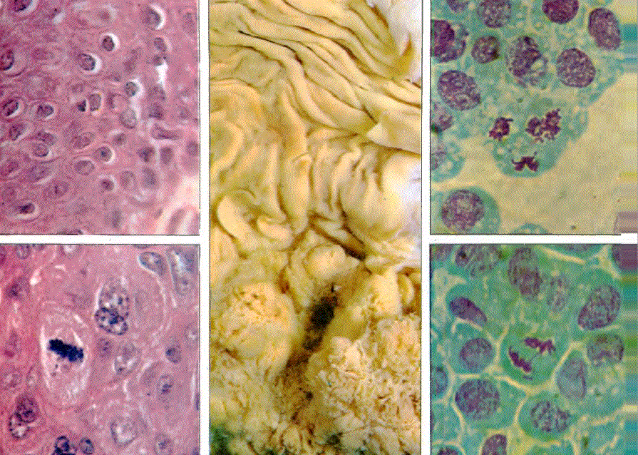 Sol üst: Normal epiderm hücreleri. Alt: Kanserleşmiş epiderm hücreleri. Orta: Mide kanseri. Adenokrısinom hücreleri (sağ üst ve alt).