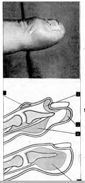 Dolama, tırnak etrafındaki iltihaplanmadır. Üstte dolamalı bir parmak alttaki iki resimde ise apsenin yerleşme yerleri görülmektedir: 1. Üst deri dolaması, 2. Tırnak kökü dolaması, 3. Alt deri yerleşimi, 4. Deri altı dokuları yerleşimi, 5. Kemik zarı yerleşimi.