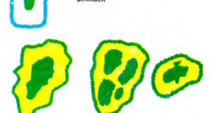 Üstte normal bir hücre/ altta ise tümör hücrelerinin şematik çizimleri görülmektedir.