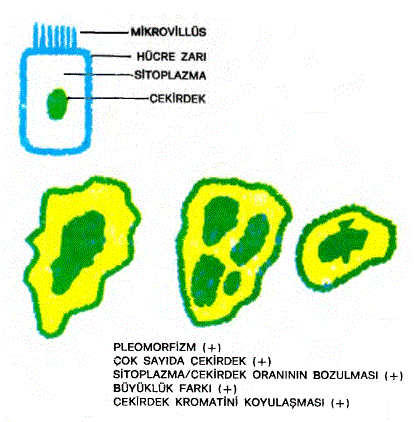 Üstte normal bir hücre/ altta ise tümör hücrelerinin şematik çizimleri görülmektedir.