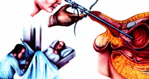 “Transüretral rezeksiyon”, bir prostat ameliyatı tekniği.